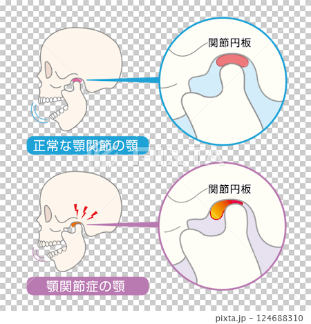 顎関節症の症状と説明のイラスト　 124688310