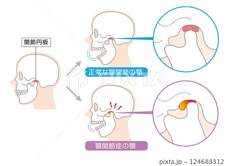 顎関節症の症状と説明のイラスト　 124688312