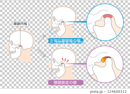 顎関節症の症状と説明のイラスト　 124688312