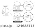 顎関節症の症状と説明のイラスト モノトーン 顎関節症の症状と説明のイラスト モノトーン 124688313