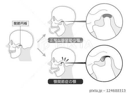 顎関節症の症状と説明のイラスト　モノトーン 124688313