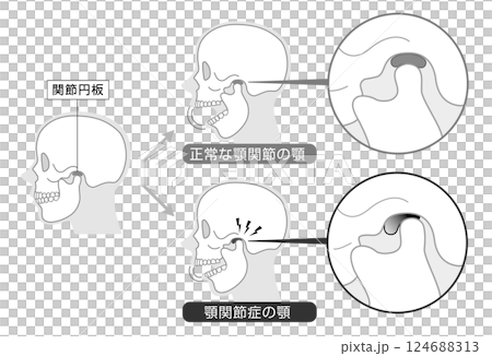 顳顎關節障礙的症狀和解釋的單調插圖 124688313