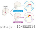 顎関節症の症状と説明のイラスト 顎関節症の症状と説明のイラスト 124688314