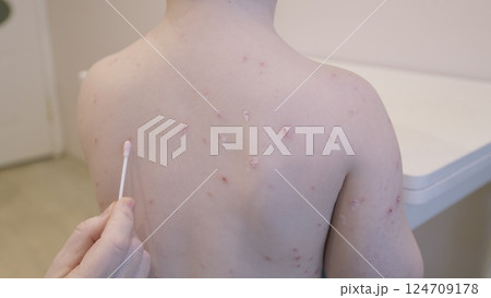 Child Suffering from Skin Condition chickenpox Accompanied by Lesions Present on Their Back 124709178