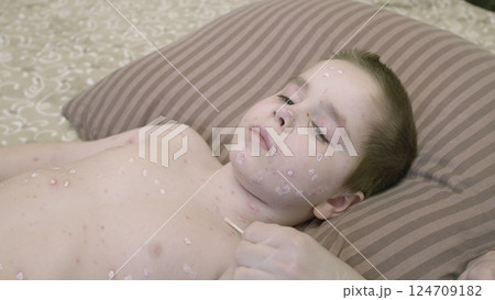 A Young Child Resting Comfortably While Calmly Dealing with a Skin Condition chickenpox on the Bed A Young Child Resting Comfortably While Calmly Dealing with a Skin Condition chickenpox on the Bed 124709182