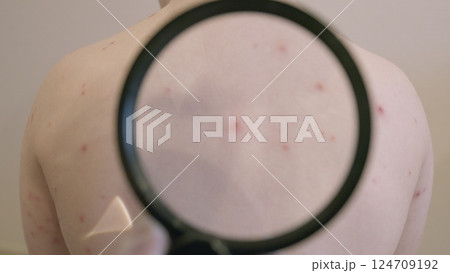 Skin Condition chickenpox That Presents with Red Spots Located on the Back Area of the Body Skin Condition chickenpox That Presents with Red Spots Located on the Back Area of the Body 124709192