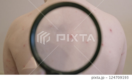 A skin condition chickenpox is clearly showcased on the back of a persons body and its appearance A skin condition chickenpox is clearly showcased on the back of a persons body and its appearance 124709193