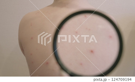 CloseUp Observation of Skin Featuring chickenpox Bumps Under a Magnifying Glass Lens 124709194
