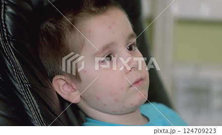A child with a skin condition chickenpox, portrayed in a pensive and thoughtful pose, evokes empathy 124709223