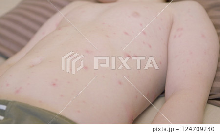 Young child with a skin rash chickenpox on their back is lying down, appearing uncomfortable and irritated Young child with a skin rash chickenpox on their back is lying down, appearing uncomfortable and irritated 124709230
