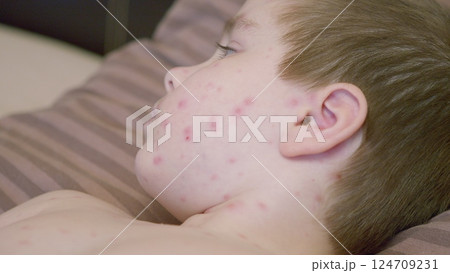 A young child with a skin condition chickenpox is lying down on a sofa, showing deep concern and emotion 124709231
