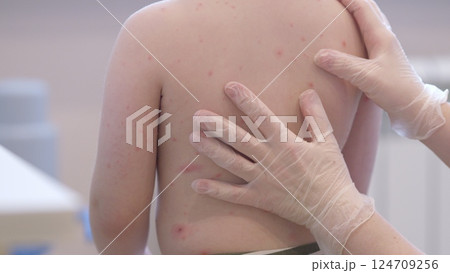 A child with a skin condition chickenpox is found enjoying themselves in a casual and playful environment 124709256