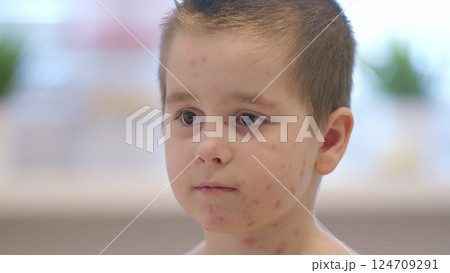 Chickenpox. A child with skin concerns is seen in a bright environment, showcasing their innocence 124709291