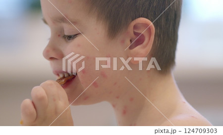 A child with skin conditions chickenpox showcasing remarkable resilience and strength in their journey 124709303