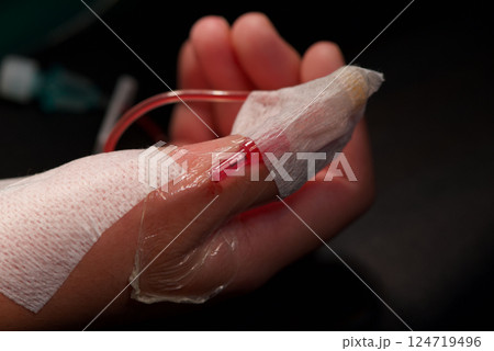 Close up of hand with medical intravenous line inserted, secured with tape, and connected to red tube 124719496