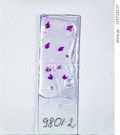 Slices of the tumor under glass. Histological examination of tumor cells for the presence of cancer 124728117