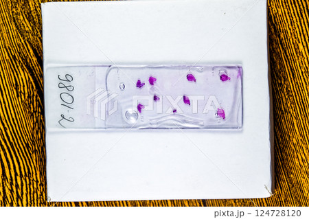 Slices of the tumor under glass. Histological examination of tumor cells for the presence of cancer 124728120