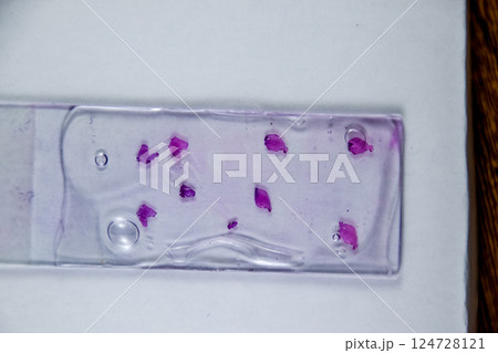 Slices of the tumor under glass. Histological examination of tumor cells for the presence of cancer 124728121