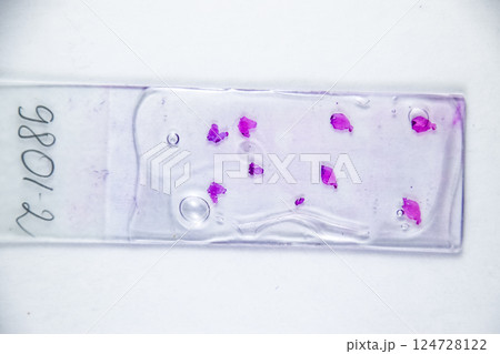 Slices of the tumor under glass. Histological examination of tumor cells for the presence of cancer 124728122