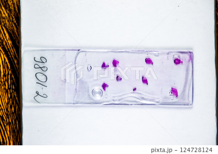 Slices of the tumor under glass. Histological examination of tumor cells for the presence of cancer 124728124