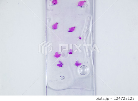Slices of the tumor under glass. Histological examination of tumor cells for the presence of cancer 124728125