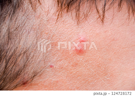 Pimples on the forehead of man. Acne on the forehead 124728172