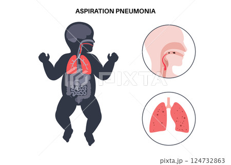 Aspiration pneumonia poster Aspiration pneumonia poster 124732863