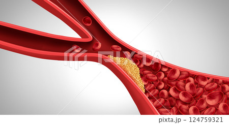 Artery Plaque 124759321