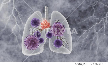 タバコの煙が肺を蝕む、肺がんのイメージの3Dイラスト  がん細胞の増殖と転移 124763138