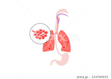 Aspiration pneumonia poster 124764935