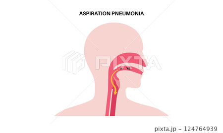 Aspiration pneumonia poster Aspiration pneumonia poster 124764939