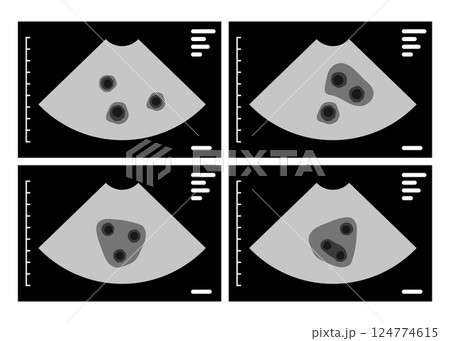 Ultrasound scan showing triplets pregnancy on monitor screen 124774615