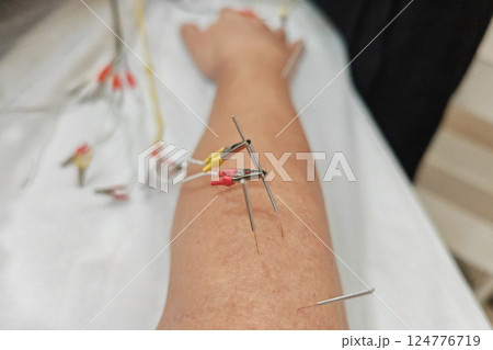 needles to arm with electric shocking in clinic. Chinese medicine 124776719