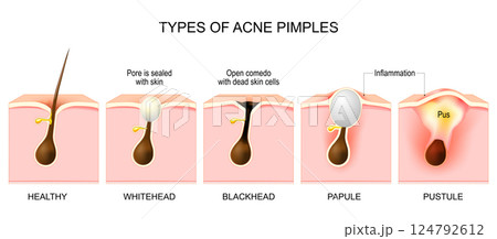 Types of acne pimples. Cross section of skin and hair follicle 124792612