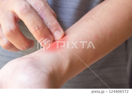 Young asian man itching and scratching on arm from allergic itchy dry skin eczema dermatitis insect bites Young asian man itching and scratching on arm from allergic itchy dry skin eczema dermatitis insect bites 124806572