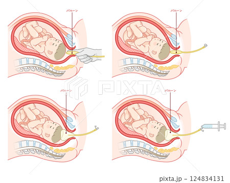 無痛分娩・バルーンのイラスト Painless childbirth illustration 無痛分娩・バルーンのイラスト Painless childbirth illustration 124834131