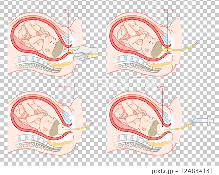 無痛分娩氣球圖 無痛分娩圖 124834131