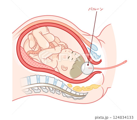 無痛分娩・バルーンのイラスト Painless childbirth illustration 無痛分娩・バルーンのイラスト Painless childbirth illustration 124834133