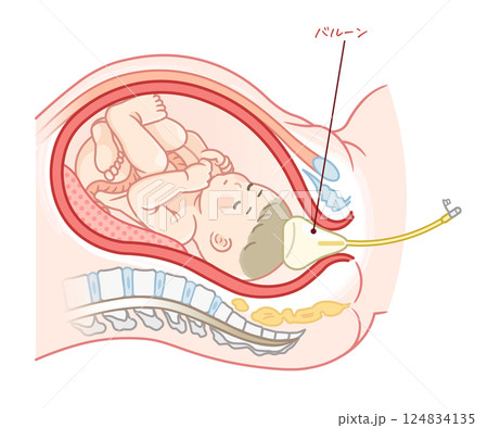 無痛分娩・バルーンのイラスト Painless childbirth illustration 無痛分娩・バルーンのイラスト Painless childbirth illustration 124834135