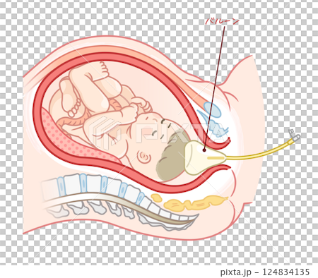 無痛分娩・バルーンのイラスト Painless childbirth illustration 無痛分娩・バルーンのイラスト Painless childbirth illustration 124834135
