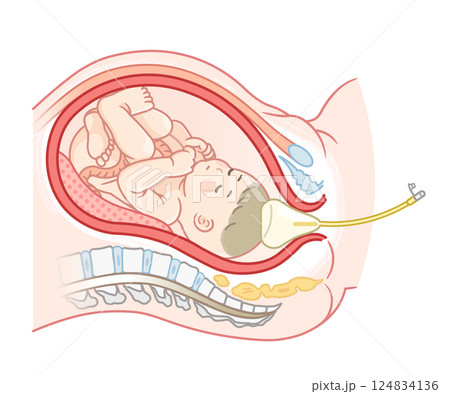 無痛分娩・バルーンのイラスト  Painless childbirth illustration 124834136