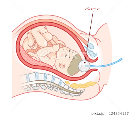 無痛分娩・バルーンのイラスト  Painless childbirth illustration 124834137