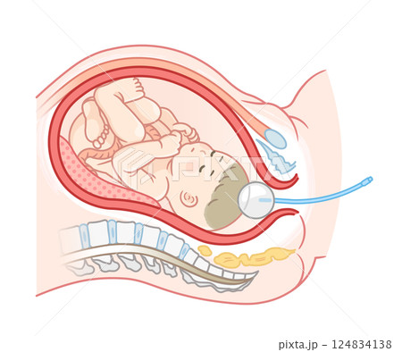 無痛分娩・バルーンのイラスト  Painless childbirth illustration 124834138