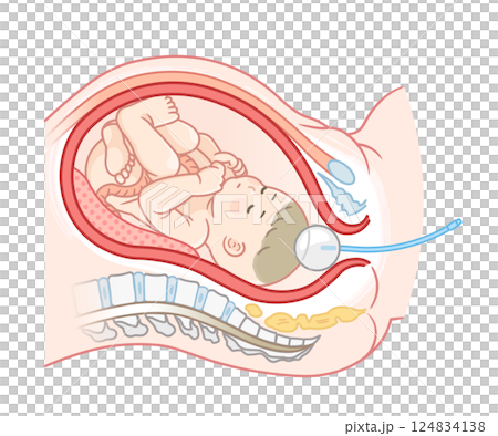 Painless childbirth balloon illustration Painless childbirth illustration 124834138