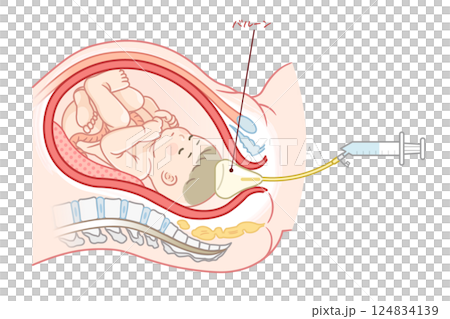 無痛分娩・バルーンのイラスト  Painless childbirth illustration 124834139