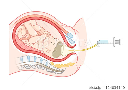 無痛分娩・バルーンのイラスト  Painless childbirth illustration 124834140