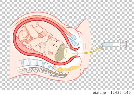 無痛分娩・バルーンのイラスト  Painless childbirth illustration 124834140