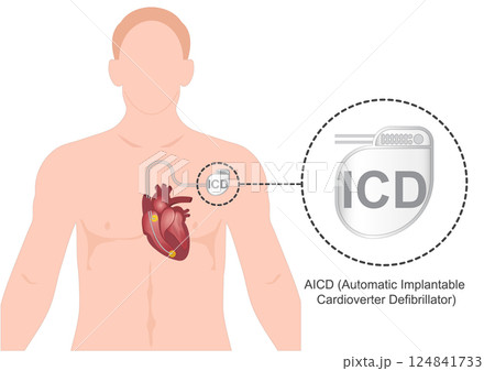 ICD or AICD is an automated implantable cardioverter defibrillator. 124841733
