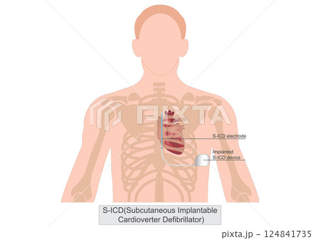 Subcutaneous implantable cardioverter defibrillator or S-ICD 124841735