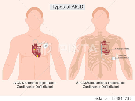 Type of AICD. 124841739